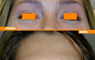 Botox o tossina botulinica 
