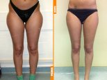 Liposcultura