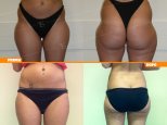 gluteoplastica
