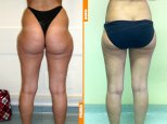 Liposcultura
