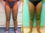 Liposcultura