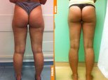 Liposcultura