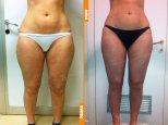liposcultura gambe