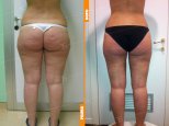 Liposcultura gambe