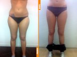 Liposcultura gambe