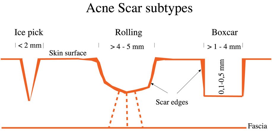 subcision filling
