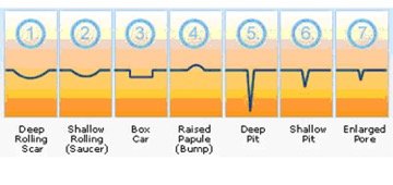subcision filling