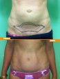 Mini addomino sintesi muscoli retti e Ombelicoplastica