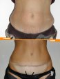 Addominoplastica, eliminazione smagliature e rinforzo parete muscolare