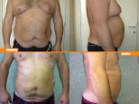 Liposcultura addome e ginecomastia uomo