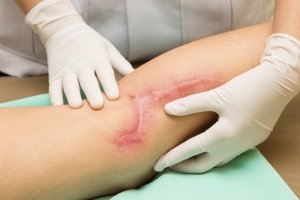 terapia delle cicatrici