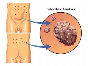 cheratosi seborroiche al microscopio