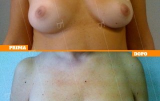 ricostruzione mammaria oncologica