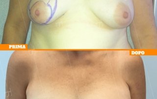 ricostruzione mammaria oncologica