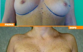 ricostruzione mammaria oncologica