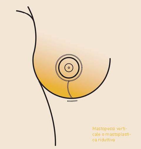 cicatrice t ad ancora mastopessi