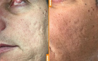 subcision filling