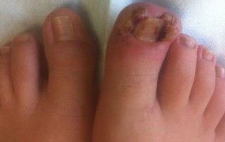 Alluce post operazione | Alluce pre operazione