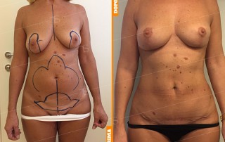 mastopessi senza protesi ibrida per aggiunta di tessuto adiposo lipofillingmastopessi senza protesi ibrida per aggiunta di tessuto adiposo lipofilling