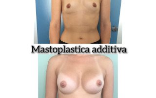 masotplastica additiva triple plan, protesi round 330 cc MP
