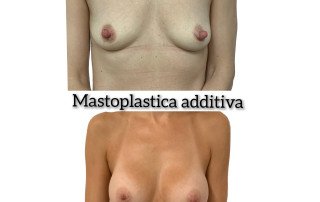 Mastoplastica additiva Motiva ergo e2sf 355 tecnica triple plane 