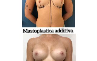 mastoplastica additiva triple plane medio profilo Motiva e2sd 360 cc