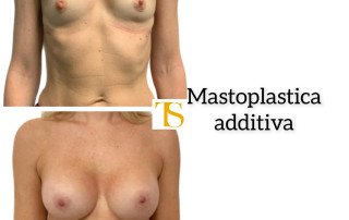 Mastoplastica additiva triple plane Motiva e2sf 355 cc 