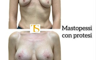 Mastopessi additiva periareolare round block triple plane protesi Motiva e2sd 360 cc